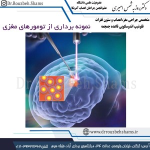 نمونه برداری از تومورهای مغزی - دکتر شمس