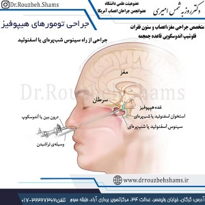 جراحی تومورهای هیپوفیز - دکتر شمس