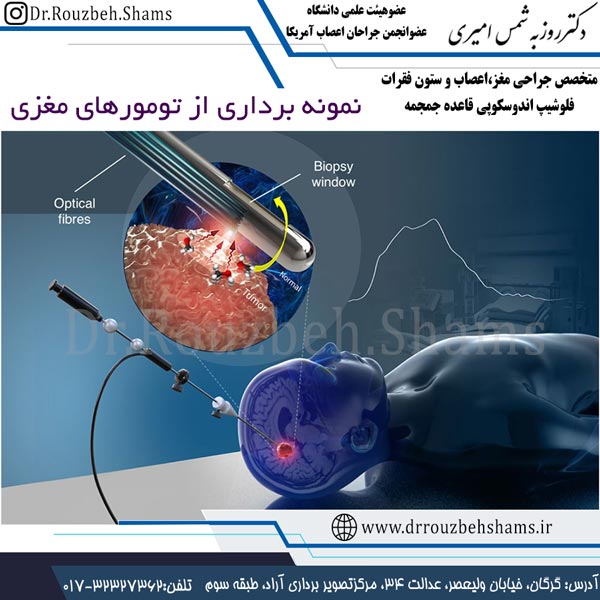نمونه برداری از تومورهای مغزی