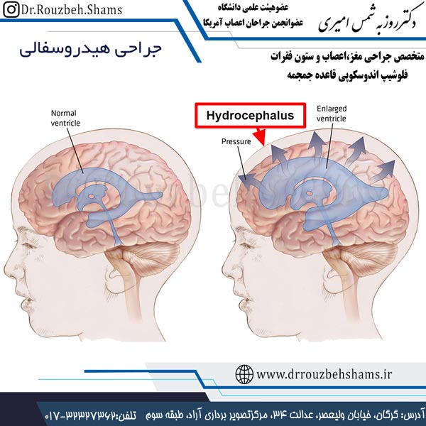 جراحی هیدروسفالی
