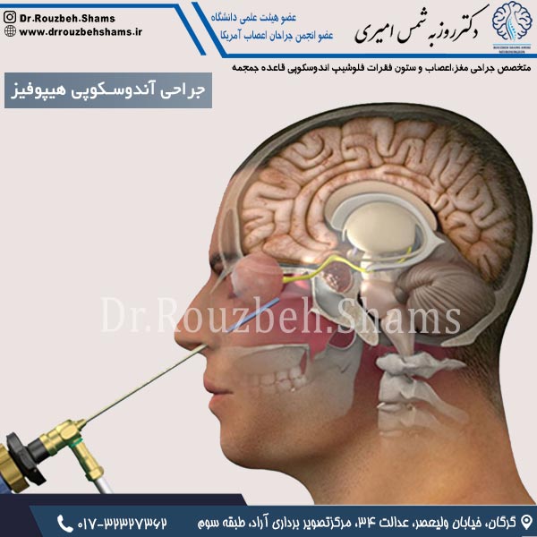 جراحی آندوسکوپی هیپوفیز