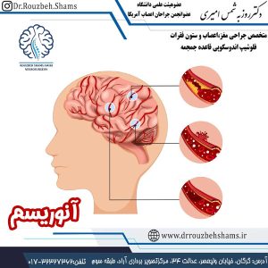 آنوریسم - متخصص مغز و اعصاب در گرگان