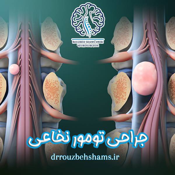 جراحی تومور نخاعی