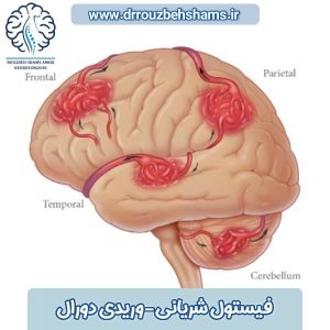 فیستول شریانی-وریدی دورال