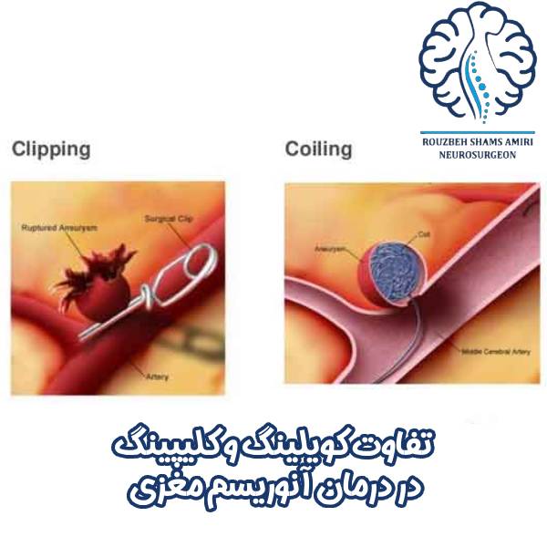 تفاوت کویلینگ و کلیپینگ در درمان آنوریسم مغزی