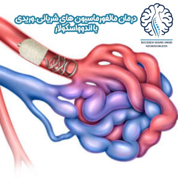 درمان مالفورماسیون های شریانی ـ وریدی با اندوواسکولار